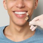 dental veneers