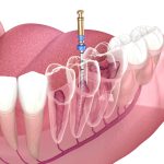 root canal therapy in woodbridge