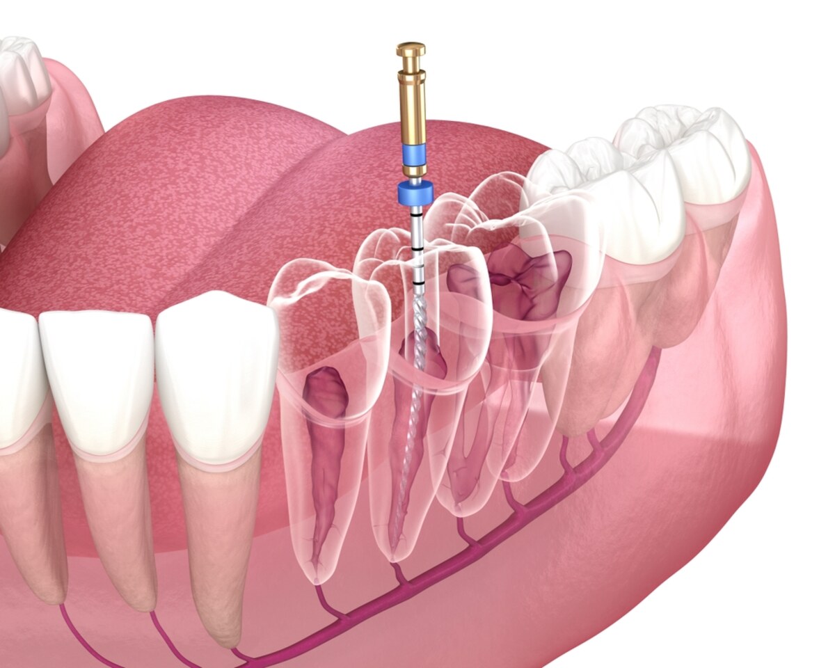 root canal therapy in woodbridge